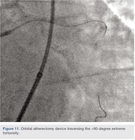 Coronary Atherectomy Part Iii Of Iii Orbital Atherectomy