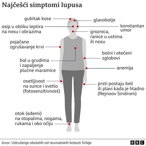 Srbija i zdravlje Šta je lupus i kako se leči BBC News na srpskom