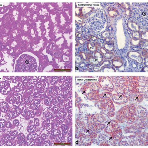 Comparison Of Irisin Expression In Benign Renal Tumor Oncocytoma To