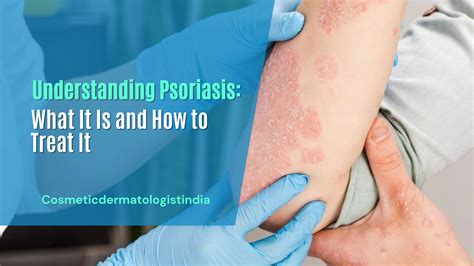 Understanding Psoriasis What It Is And How To Treat It Cosmetic Dermatologist India