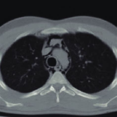 Diffuse Pneumomediastinum On Computed Tomography Ct Of The Third