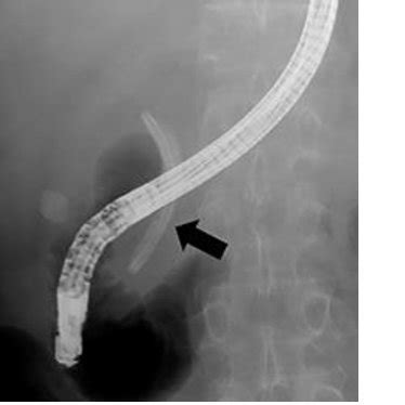 (PDF) Successful Endoscopic Removal of a Biliary Stent with Stent-Stone ...