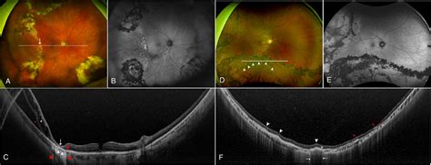 Rhegmatogenous Retinal Detachment Oct