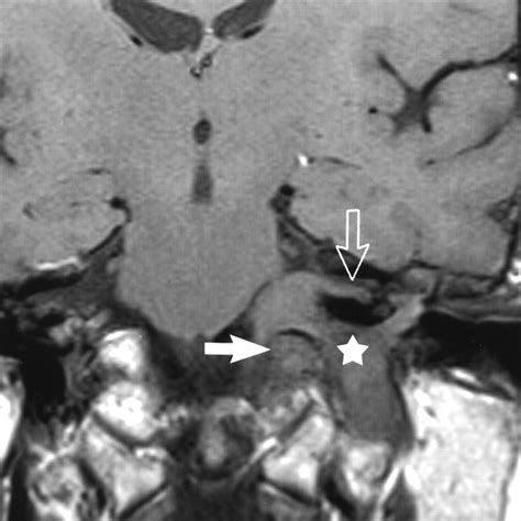 Jugular Foramen Mri