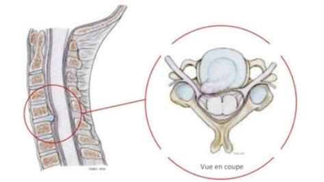 Hernie discale cervicale et névralgie cervico brachiale Centre du Rachis