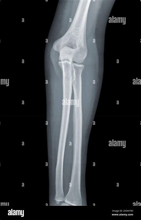 Elbow X-ray negative Stock Photo - Alamy