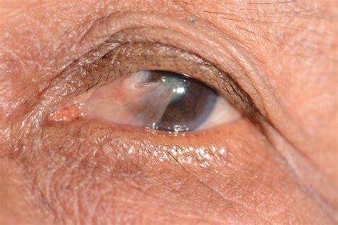 Pterygium Surfers Eye Symptoms Causes And Treatment Lions Eye