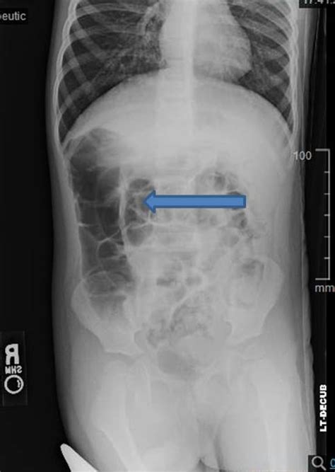 Keep Your Eye On The Target POCUS For Intussusception BROWN