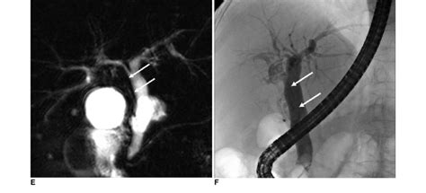 81 Year Old Woman With Duplication Of Extrahepatic Bile Duct E MR