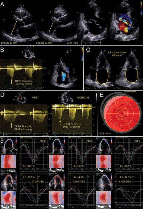 Examples Of Echocardiographic Prognostic Parameters In Severe Primary