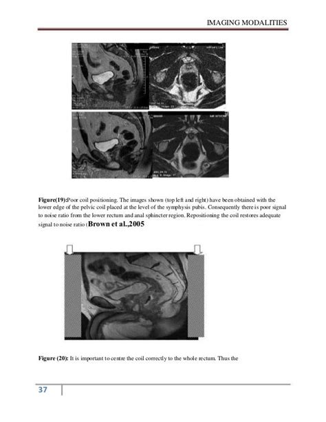 mri of rectal cancer