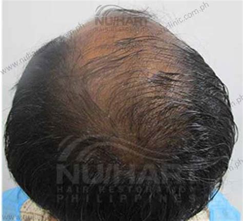 Nuhart14 Nuhart Hair Restoration Philippines