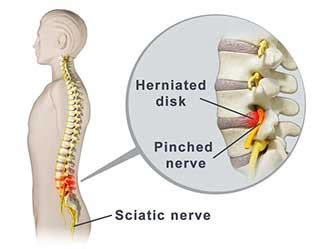 Pinched Nerve, Radiculopathy, Back Pain, Neck Pain