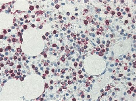 Dba Positive Cells In The Bone Marrow Biopsy From A Patient With