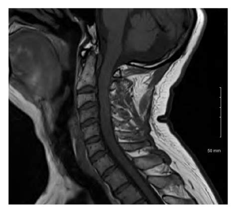 Preoperative T Sequence Mri Of The Cervical Spine Sagittal Images