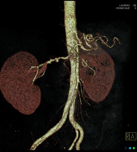 Fibromuscular Dysplasia Right Renal Artery Image