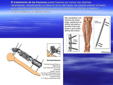 Fijadores Externos By Formacion Axarquia Issuu