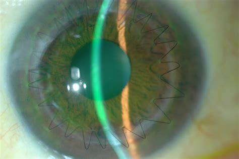 Corneal Transplant Surgery Options - Discovery Eye Foundation