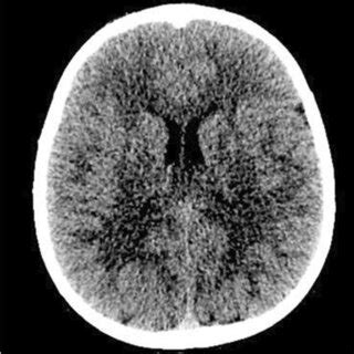 Axial Non Contrast Head Computed Tomography Image Brain Windows