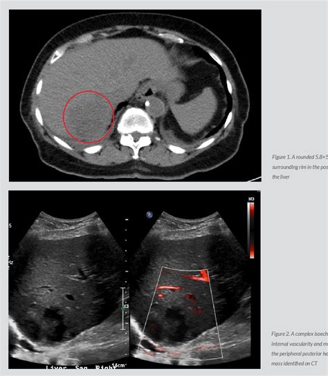 Figure 2 From Cryptogenic Pyogenic Liver Abscess Due To Fusobacterium Nucleatum In An