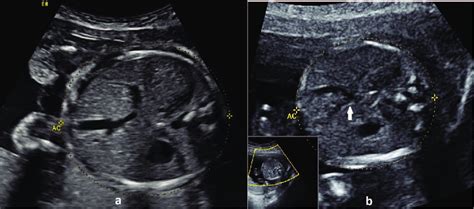 Umbilical Vein Ultrasound