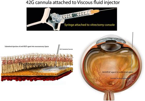 Preparation Of The Subretinal Agent Delivery System A Prepared 1 ML