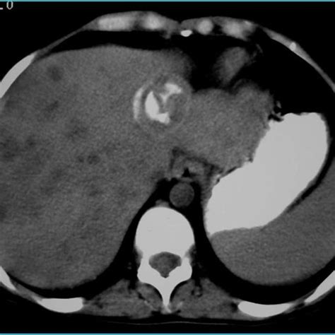 Pdf Rare Presentations And Complications Of Hepatic Hydatid Cysts