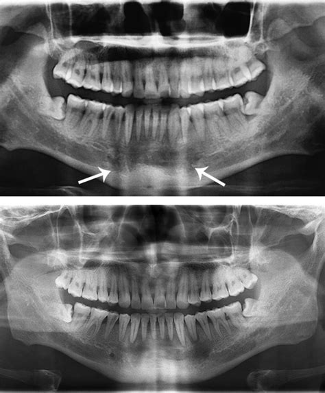 Tuberculous Osteomyelitis Of The Mandible With Diffuse Swelling Of The Floor Of The Mouth A