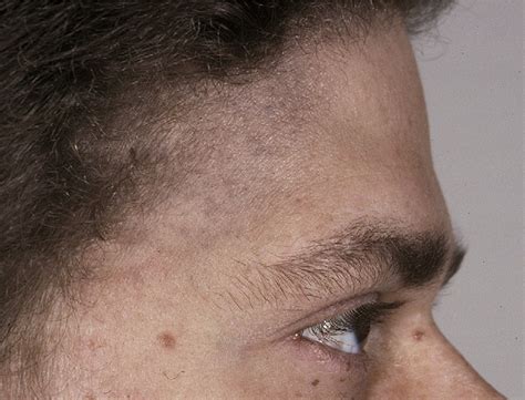 Figure 1 From Iris Melanoma Arising In Iris Nevus In Oculodermal