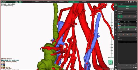 3d Imaging For Nephroureterectomy With Resection Of The Studer