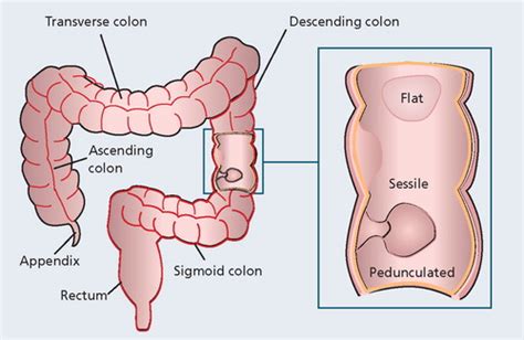 Colon Polyps Types Symptoms And Diagnosis 58 Off