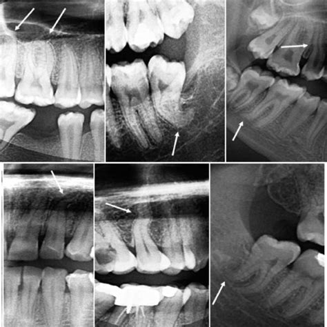 Examples Of Root Dilacerations On Formed Panoramic Radiographs