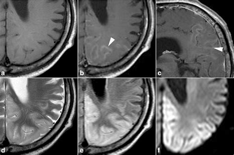 Hepatic Encephalopathy Mri