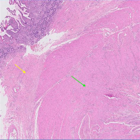 (PDF) A case report of inverted Meckel's diverticulum