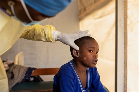 Unicef solicita 16 5 millones de dólares para combatir la mpox en