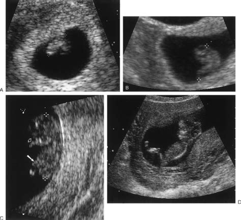 Ultrasound Evaluation During The First Trimester Of Pregnancy