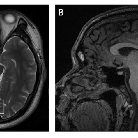 Placement Of The Single Voxel In The Axial A And Sagittal B