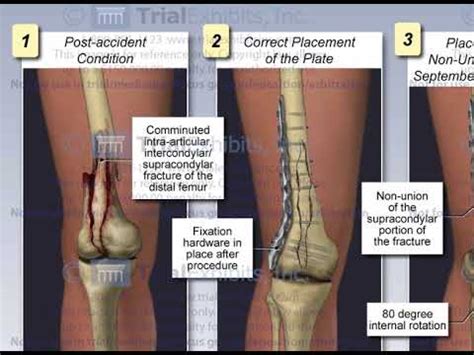 Open Distal Femur Fracture