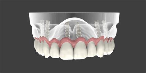 Implant Supported Dentures | Dental Implants