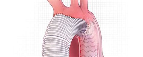 Aortic Repair Procedure Types At Emory Aortic Center