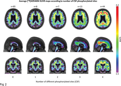 Ptau Heterogeneity As A Measure For Disease Severity In Incipient