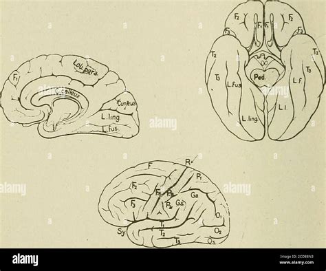 Medical And Surgical Therapy Fissures Of Rolando Of Which It Forms