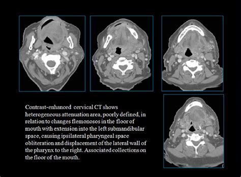 Ludwigs Angina Ct Findings Semantic Scholar