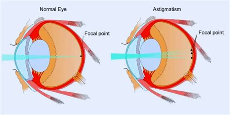 Astigmatism Symptoms Causes Prevention And Treatment