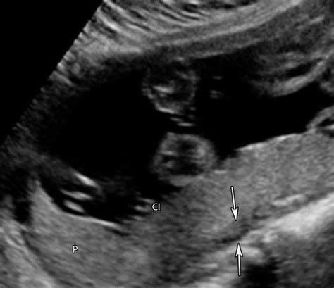 Placental Imaging Normal Appearance With Review Of Pathologic Findings