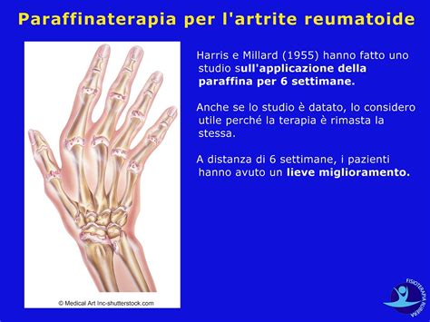 Paraffinoterapia Alle Mani Per L Artrosi Della Dita E Controindicazioni