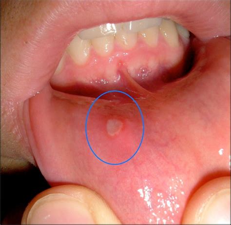 Ulcer Aphthous Causes Symptoms And Treatment Options Health And