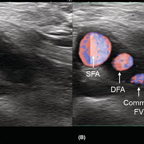 A Vascular Ultrasound Image Of The Right Groin B Systolic Phase Download Scientific