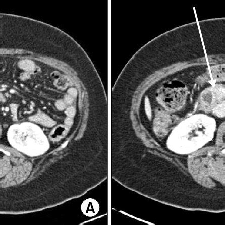 Previous Abdominal CT Scan A And 4 Month Follow Up Abdominal CT Scan