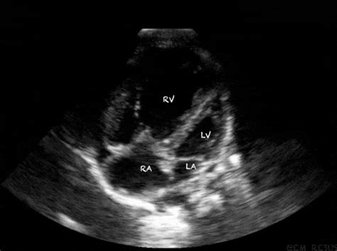 Total Anomalous Pulmonary Venous Return (TAPVR) Here's the bedside Echo